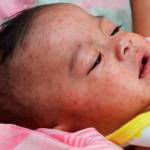 Infant with measles. Photo courtesy of Washington State Department of Health/Centers for Disease Control